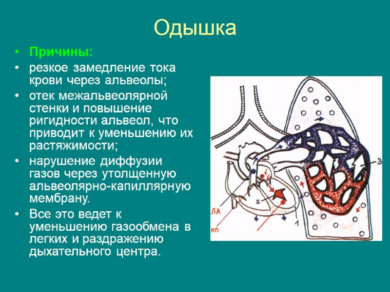 Одышка  Причины: резкое замедление тока крови через альвеолы; отек межальвеолярной стенки и повышение